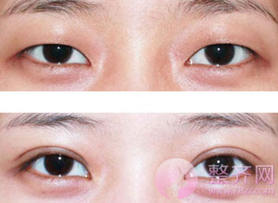 眼部整形四个方向无短板才算