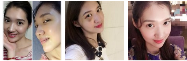 自体脂肪丰面颊好不好?多少钱?