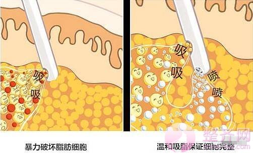 自体脂肪丰胸,脂肪才是重点