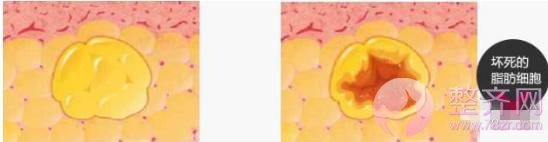 自体脂肪丰胸,脂肪才是重点