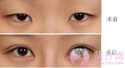 割双眼皮也有潜规则