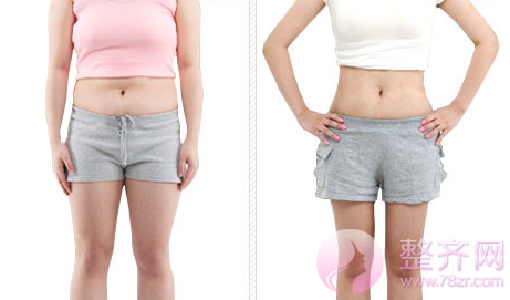 吸脂减肥适合哪些部位?