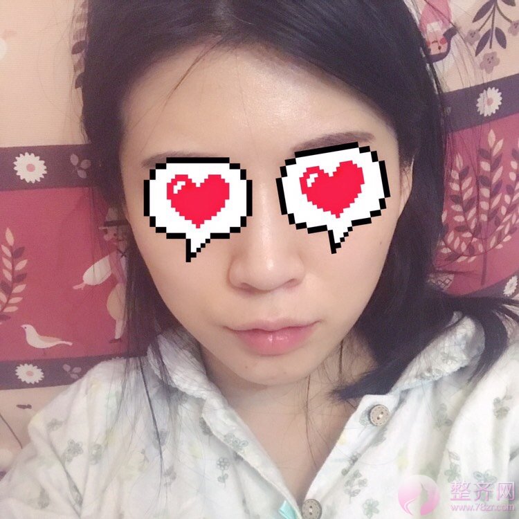 自体脂肪填充全脸术后案例