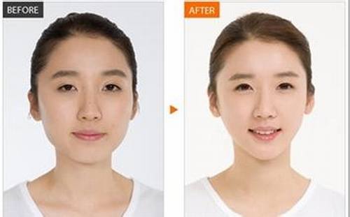 减脂瘦脸怎么样？多少钱？