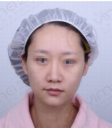 北京艺美王东做自体脂肪填充怎么样？多少钱？