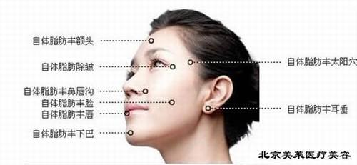 北京艺美王东做自体脂肪填充怎么样？多少钱？