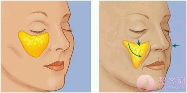 脂肪面部填充真的这么好?