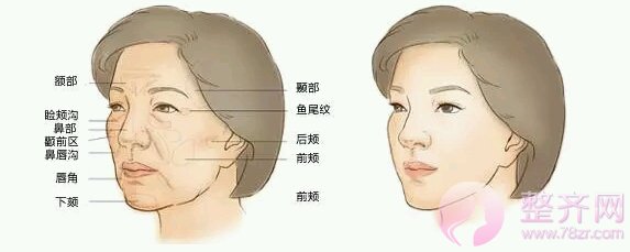 脂肪面部填充真的这么好?