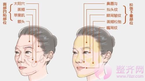 脂肪填充让你美的迹