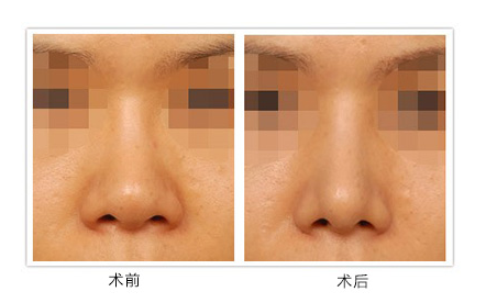 北京伊美尔紫竹医疗美容医院鼻头缩小手术的注