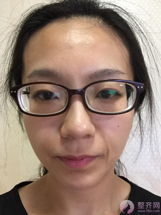 脂肪填充,埋线双眼皮,开前眼角手术