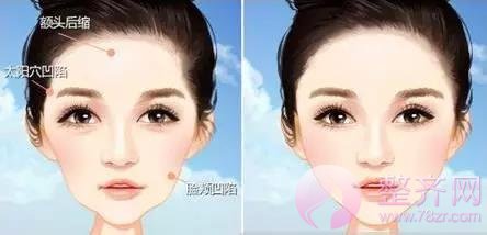 自体脂肪填充,让你拥有美女的容颜!