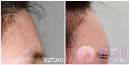 自体脂肪填充,让你拥有美女的容颜!