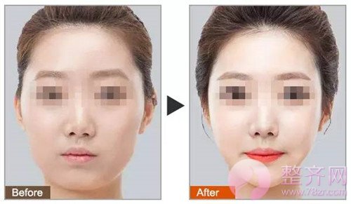 自体脂肪填充,让你拥有美女的容颜!