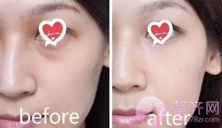 自体脂肪填充,让你拥有美女的容颜!