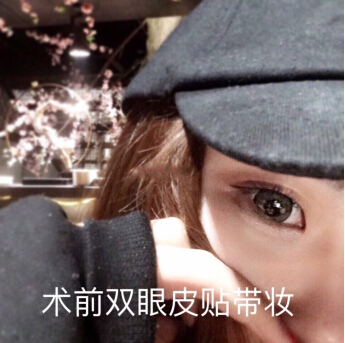 无锡丽都林院长做的双眼皮开眼角去皮去脂