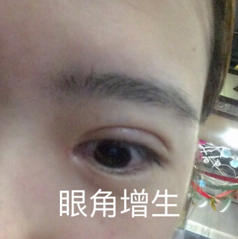 无锡丽都林院长做的双眼皮开眼角去皮去脂