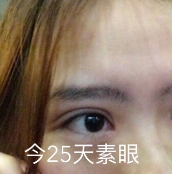 无锡丽都林院长做的双眼皮开眼角去皮去脂