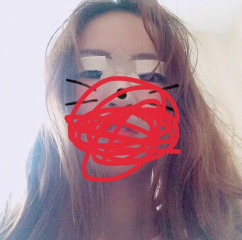 无锡丽都林院长做的双眼皮开眼角去皮去脂