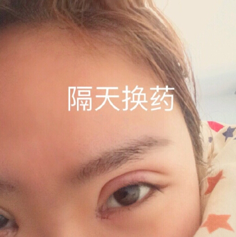 无锡丽都林院长做的双眼皮开眼角去皮去脂