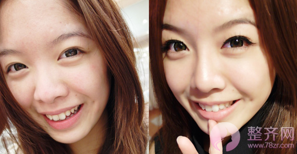 两眼间距过宽，有什么办法改良？