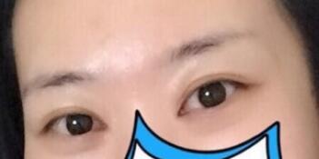 做完双眼皮已经两年了,希望分享经验帮到大家