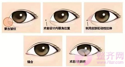 双眼皮+开眼角=电眼