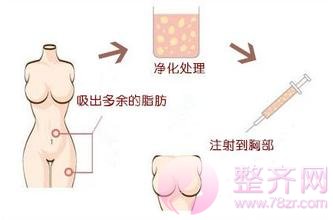 体脂肪隆胸:不做男人一手掌握的女人。