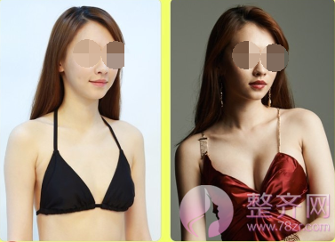 体脂肪隆胸:不做男人一手掌握的女人。