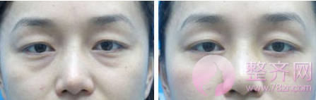 如何有改良眼袋？