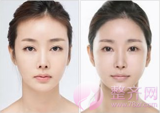 为什么做自体脂肪就能显年轻?