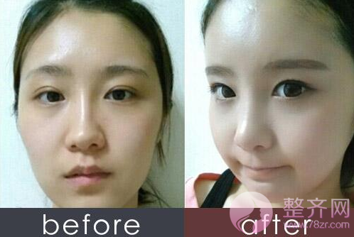 脂肪移植填充不自然?