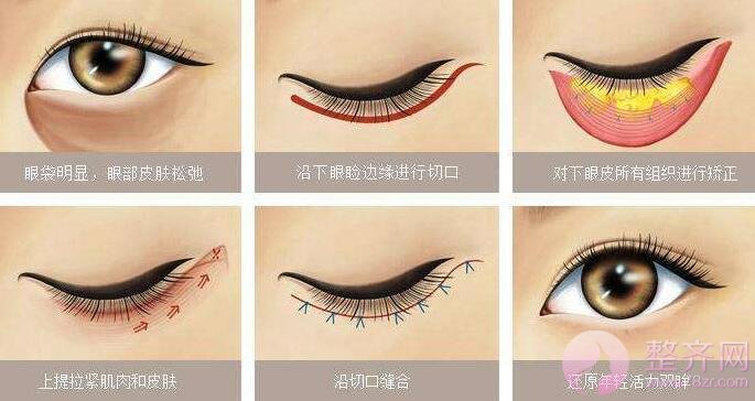 对于眼袋你不得不了解的事情！