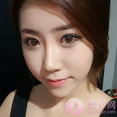 自体脂肪填充如何避免“充气脸”?