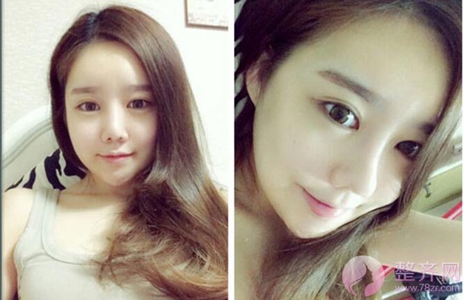 自体脂肪填充如何避免“充气脸”?