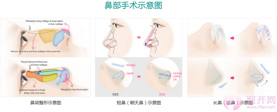 隆鼻≠综合隆鼻!你知道吗?
