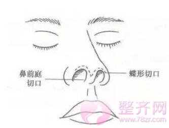 隆鼻≠综合隆鼻!你知道吗?