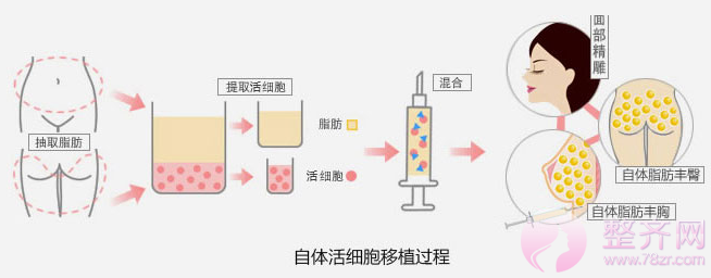 面部脂肪填充的介绍