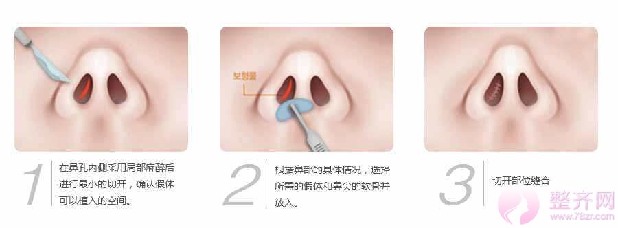 眼部、鼻部、隆胸、的切口都藏在哪里?