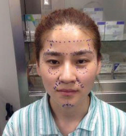 全脸脂肪填充手术一个月了，柔和的脸型才美