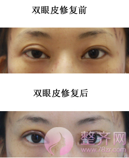 眼部修复的六种类型