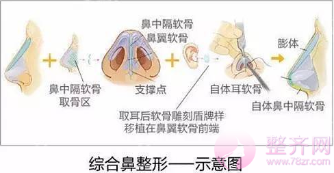 隆鼻和鼻部手术差别在哪？哪种更自然？