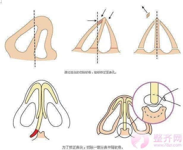 隆鼻：跟恋爱一样，适合你的就是较好的！