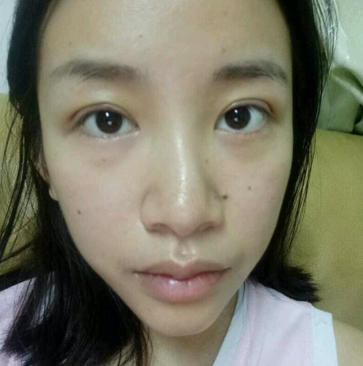 广州健丽医疗美容韩式三点双眼皮案例