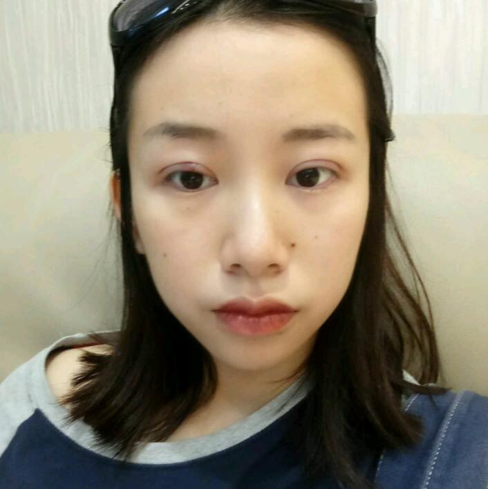 广州健丽医疗美容韩式三点双眼皮案例