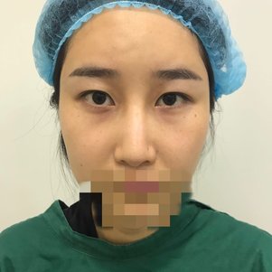杭州伊琳医疗美容毛琪医生切双眼皮开眼角案例
