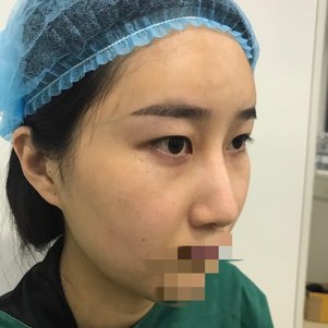 杭州伊琳医疗美容毛琪医生切双眼皮开眼角案例