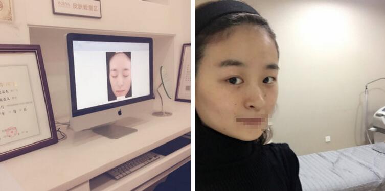 激光祛斑对比图 激光祛斑对比图