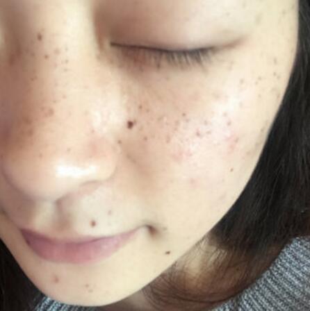 激光祛斑对比图 激光祛斑对比图