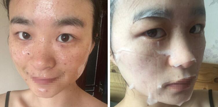 激光祛斑对比图 激光祛斑对比图